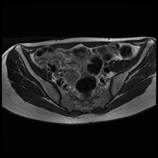 File:Normal female pelvis MRI (retroverted uterus) (Radiopaedia 61832-69933 Axial T2 12).jpg