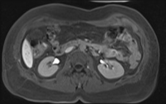 File:Normal hepatobiliary phase liver MRI (Radiopaedia 58968-66230 A 66).jpg