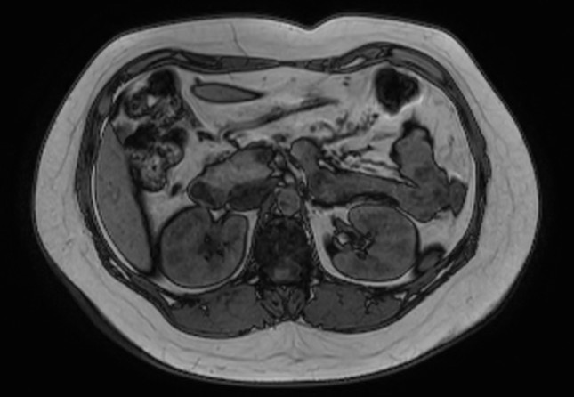 File:Normal liver MRI with Gadolinium (Radiopaedia 58913-66163 B 16).jpg