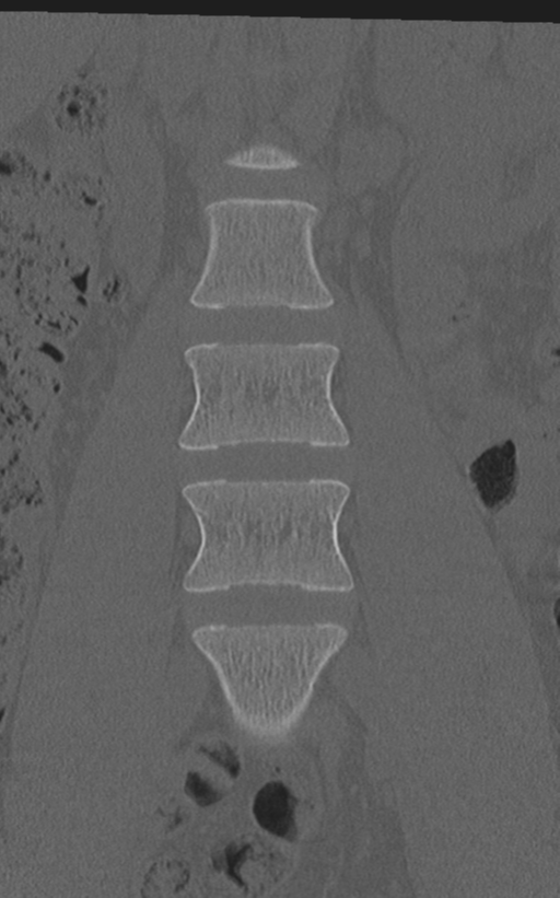 Normal lumbar spine CT (Radiopaedia 46533-50986 Coronal bone window 22).png
