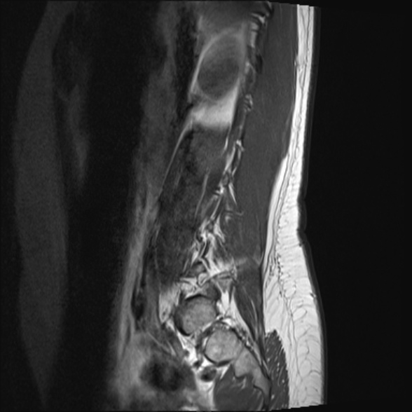 File:Normal lumbar spine MRI- 3 T (Radiopaedia 53280-59250 Sagittal T1 4).jpg