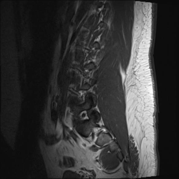 File:Normal lumbar spine MRI (Radiopaedia 47857-52609 Sagittal T1 3).jpg
