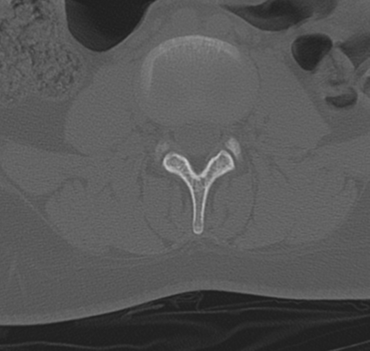 File:Normal lumbosacral CT (Radiopaedia 37923-39867 Axial bone window 57).png