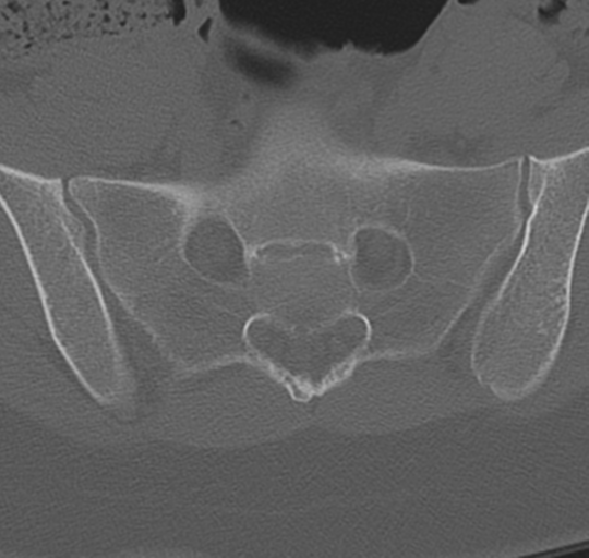 File:Normal lumbosacral CT (Radiopaedia 37923-39867 Axial bone window 87).png