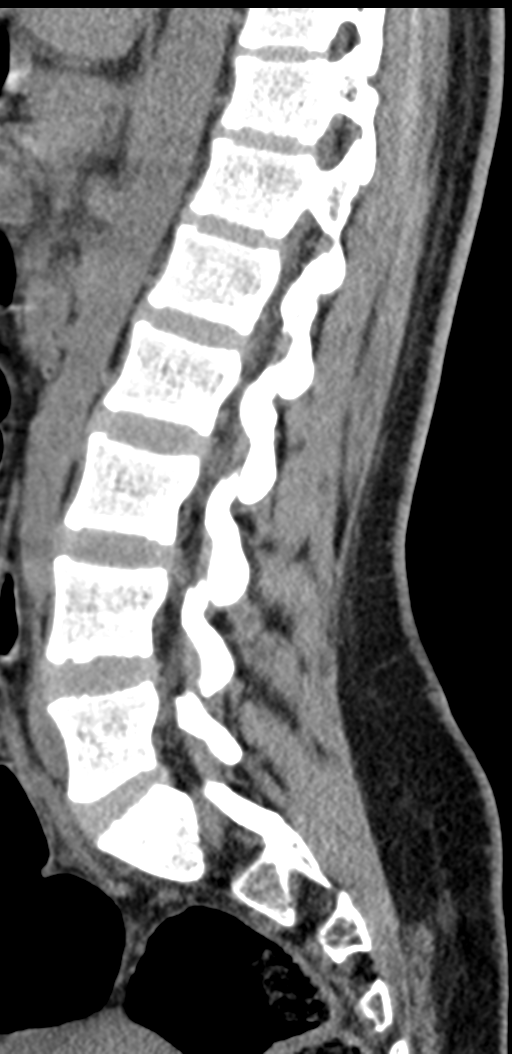 Normal lumbosacral CT (Radiopaedia 37923-39867 E 49).png