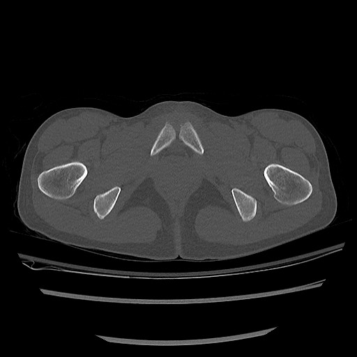 Normal pelvis CT (Radiopaedia 51471-57236 Axial bone window 90).jpg