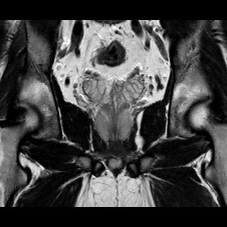 File:Normal prostate (MRI) (Radiopaedia 29986-30535 Coronal T2 13).jpg