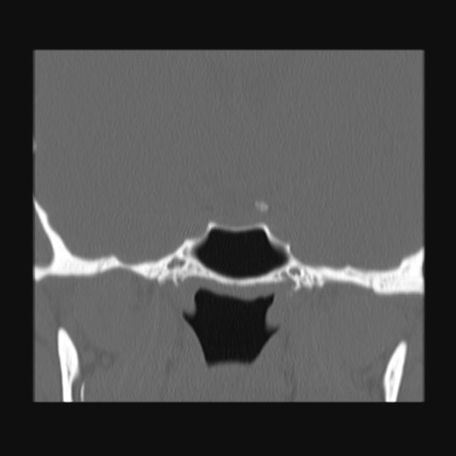Normal sinus CT (annotated) (Radiopaedia 78917-91810 Coronal bone window 48).jpg