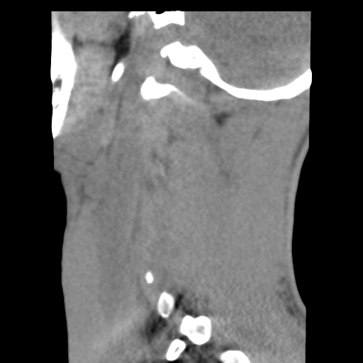 File:Normal trauma cervical spine (Radiopaedia 41017-43760 B 25).png