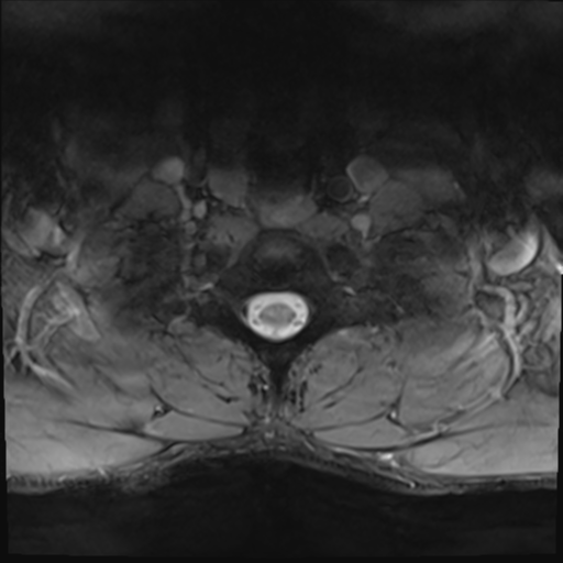File:Normal trauma cervical spine (Radiopaedia 41017-43762 Axial T2 27).png