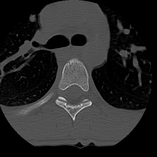Normal trauma spine imaging (age 16) (Radiopaedia 45335-49358 Axial bone window 114).jpg