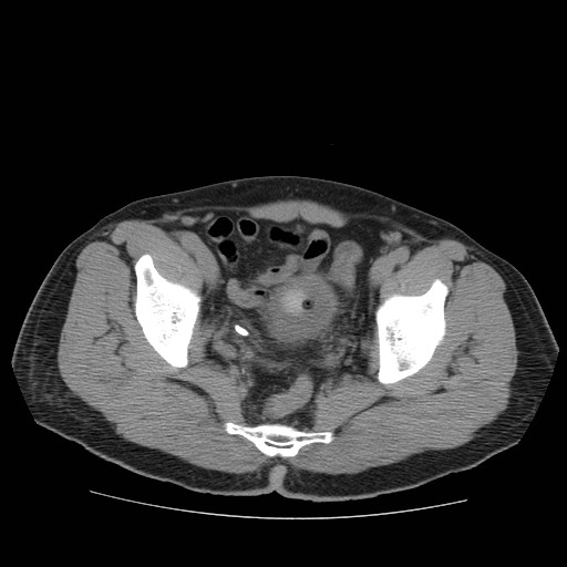 File:Obstructed kidney with perinephric urinoma (Radiopaedia 26889-27067 Axial non-contrast 47).jpg
