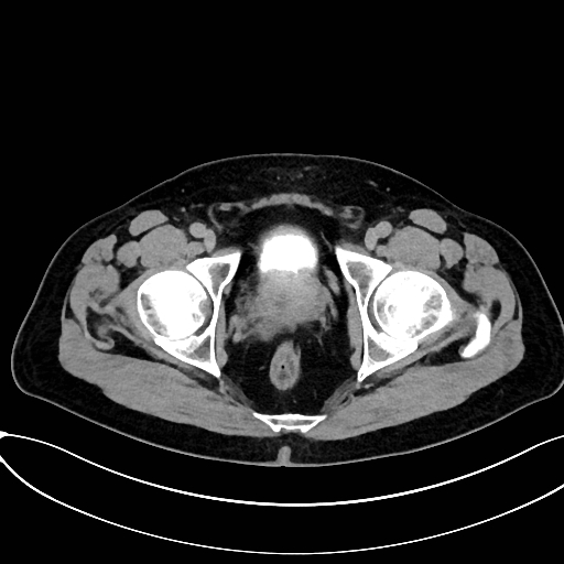 Obstructed upper pole ureter in a duplex kidney (Radiopaedia 54935-61221 Axial C+ delayed 108).jpg