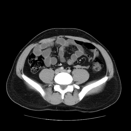 File:Obstructing ureteric calculus (Radiopaedia 18615-18514 B 36).jpg