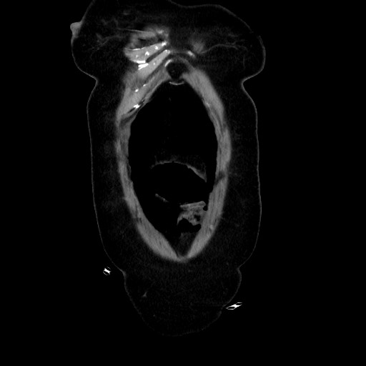 Obstructive distal colonic adenocarcinoma causing cecal perforation (Radiopaedia 86830-102989 C 42).jpg