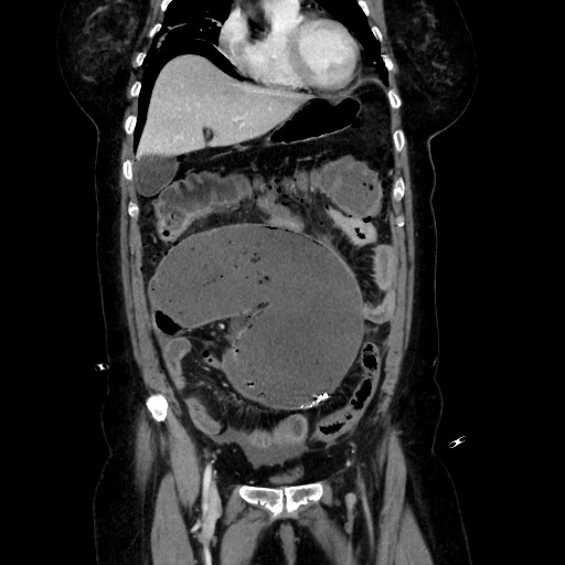 Obstructive distal colonic adenocarcinoma causing cecal perforation (Radiopaedia 86830-102989 C 72).jpg