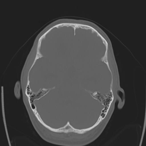File:Obstructive hydrocephalus (Radiopaedia 30453-31119 Axial bone window 22).jpg