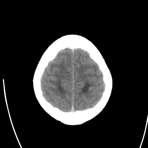 File:Obstructive hydrocephalus (Radiopaedia 30453-31119 Axial non-contrast 24).jpg