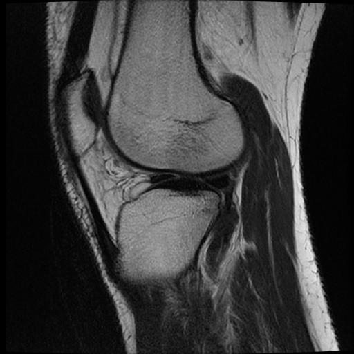 File:ACL acute full thickness tear - deep lateral femoral sulcus sign (Radiopaedia 38594-40740 Sagittal T2 15).jpg