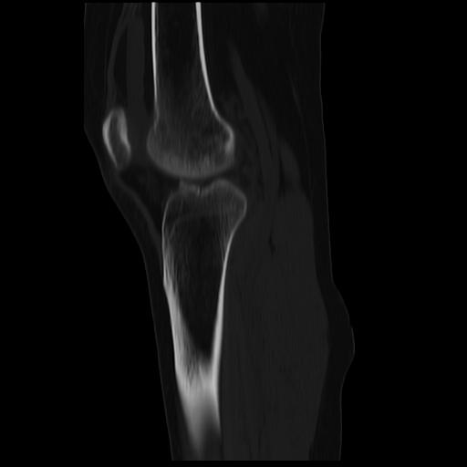 File:ACL avulsion fracture (Radiopaedia 33833-34994 Sagittal bone window 19).jpg