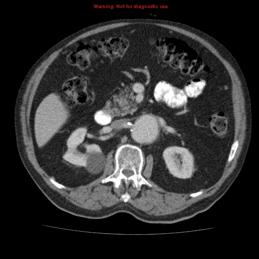Abdominal aortic aneurysm (Radiopaedia 10122-10660 Axial C+ portal venous phase 28).jpg