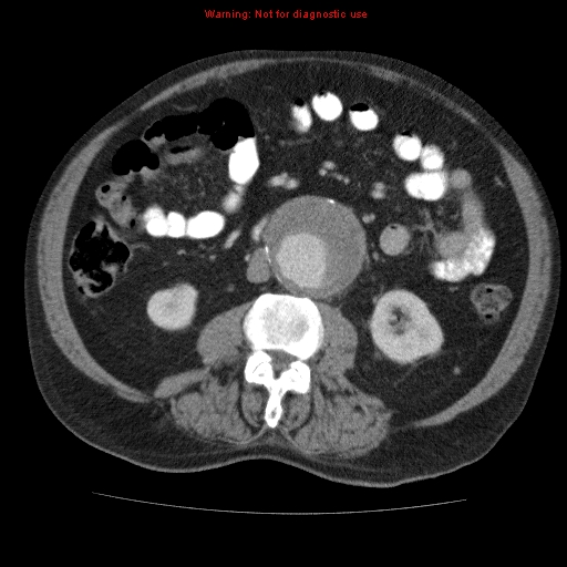 File:Abdominal aortic aneurysm (Radiopaedia 10122-10660 Axial C+ portal venous phase 40).jpg