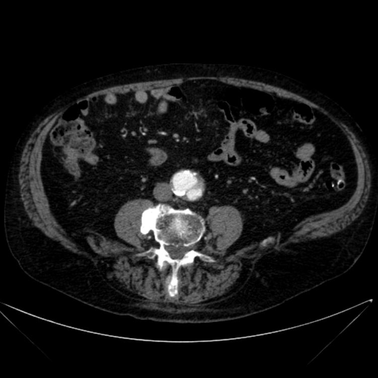 Abdominal aortic aneurysm (Radiopaedia 25855-26001 Axial C+ arterial phase 82).jpg