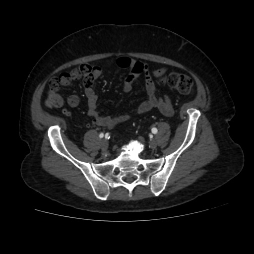 File:Abdominal aortic aneurysm (Radiopaedia 57318-64259 Axial C+ arterial phase 55).jpg