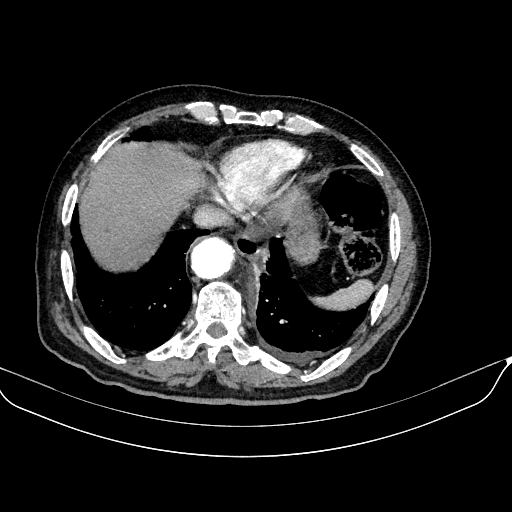 Abdominal aortic aneurysm (Radiopaedia 67117-76452 Axial C+ arterial phase 16).jpg