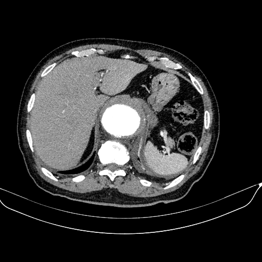 Abdominal aortic aneurysm (Radiopaedia 67117-76452 Axial C+ arterial phase 27).jpg