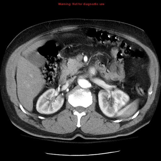 Abdominal aortic aneurysm (Radiopaedia 8190-9038 Axial C+ arterial phase 30).jpg