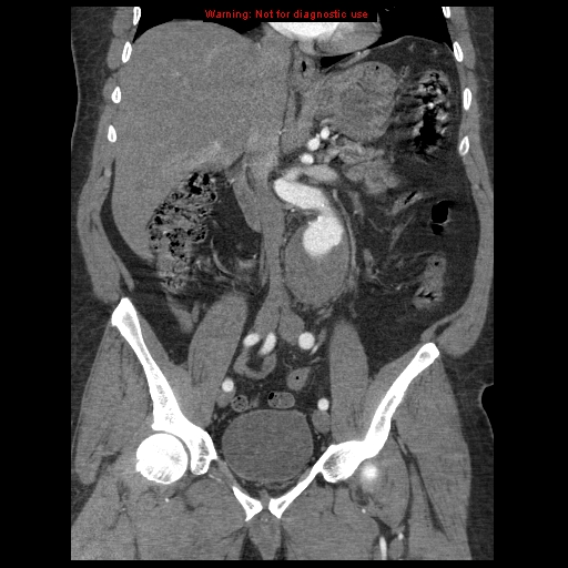 Abdominal aortic aneurysm (Radiopaedia 8190-9038 Coronal C+ arterial phase 64).jpg