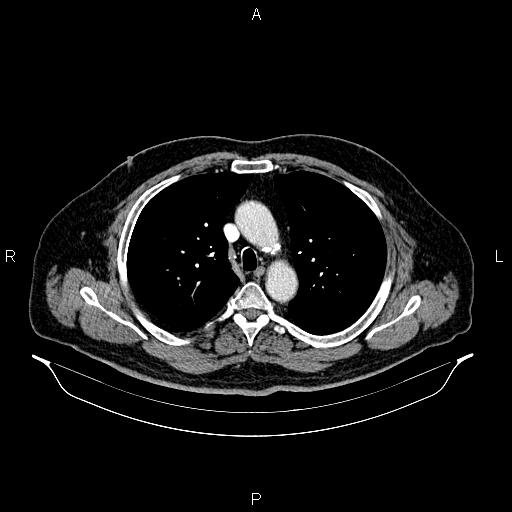 Abdominal aortic aneurysm (Radiopaedia 83094-97462 Axial renal cortical phase 27).jpg