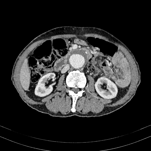 Abdominal aortic aneurysm (Radiopaedia 83581-98689 Axial C+ portal venous phase 55).jpg