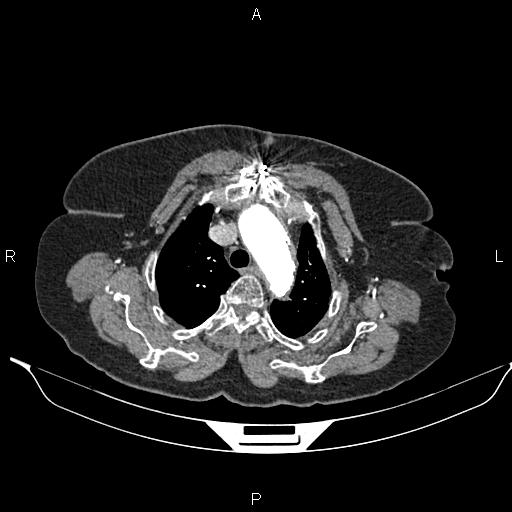 File:Abdominal aortic aneurysm (Radiopaedia 85063-100606 Axial C+ arterial phase 10).jpg