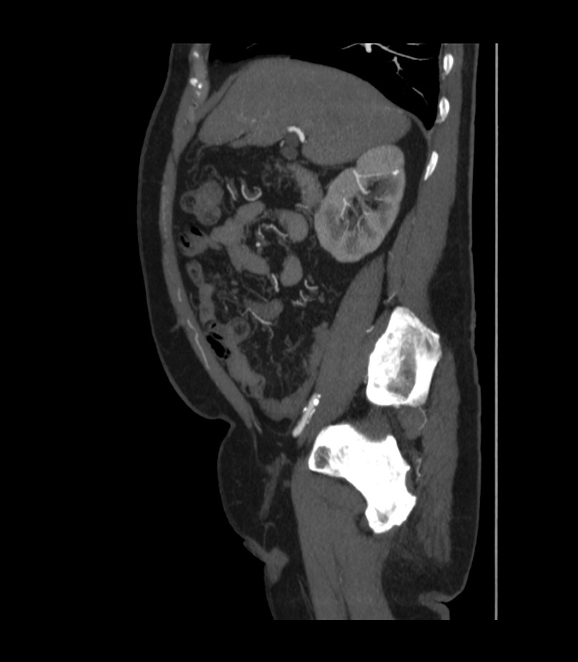 Abdominal aortic aneurysm with thrombus fissuration (Radiopaedia 46218-50618 Sagittal C+ arterial phase 19).jpg
