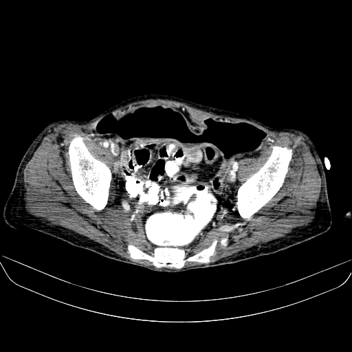 File:Abdominal collection due to previous cecal perforation (Radiopaedia 80831-94320 Axial C+ portal venous phase 175).jpg