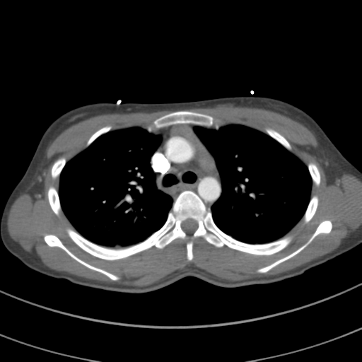 File:Abdominal multi-trauma - devascularised kidney and liver, spleen and pancreatic lacerations (Radiopaedia 34984-36486 Axial C+ arterial phase 30).png