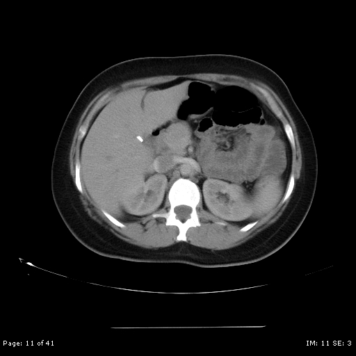 File:Abdominal wall endometriosis (Radiopaedia 25723-25885 Axial C+ portal venous phase 11).jpg