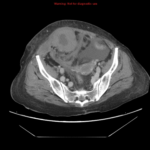 File:Abdominal wall hematoma (Radiopaedia 9427-10112 Axial C+ portal venous phase 86).jpg
