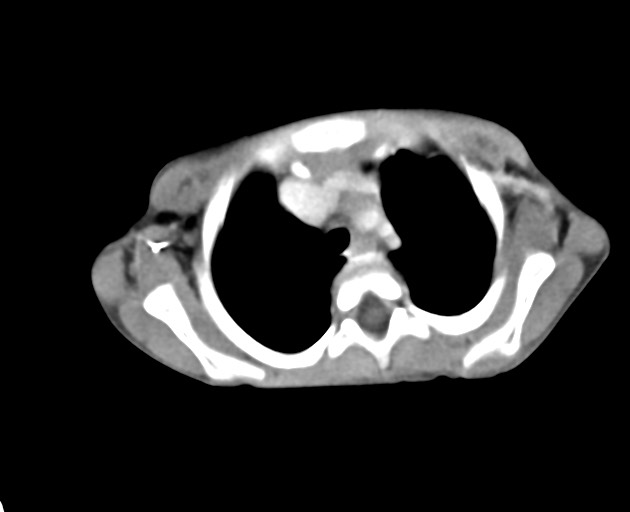 File:Abdominopelvic rhabdomyosarcoma (Radiopaedia 78356-90984 Axial C+ portal venous phase 7).jpg