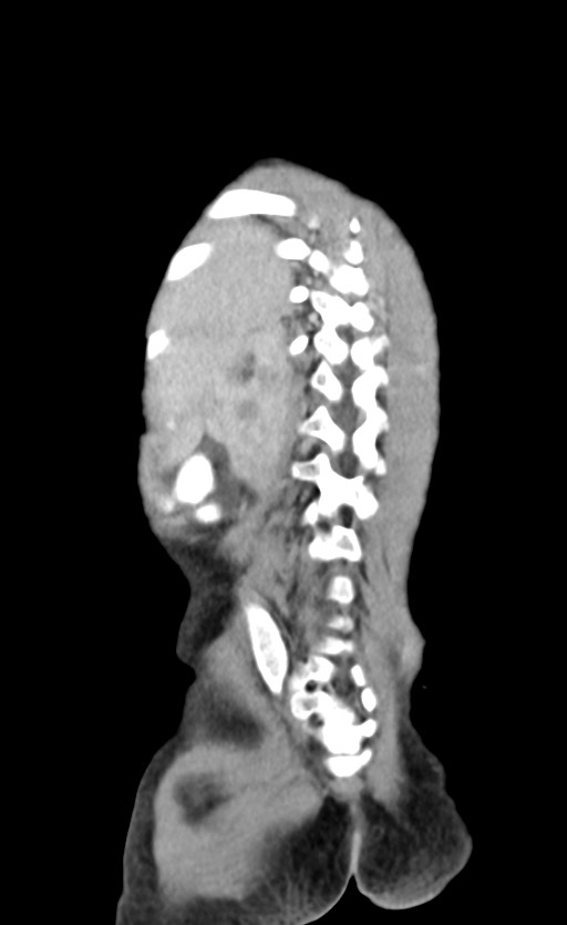 Abdominopelvic rhabdomyosarcoma (Radiopaedia 78356-90984 Coronal C+ portal venous phase 80).jpg