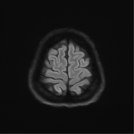 Abducens nerve palsy (Radiopaedia 51069-56648 Axial DWI 51).png