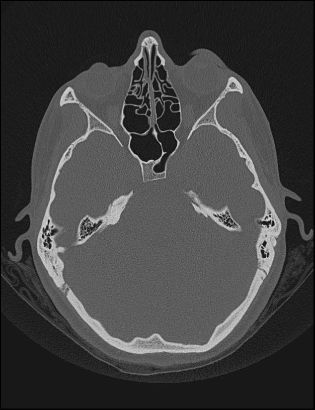 Aberrant right internal carotid artery (Radiopaedia 65191-74198 Axial non-contrast 58).jpg