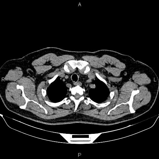 Aberrant right subclavian artery (Radiopaedia 87093-103354 Axial non-contrast 15).jpg