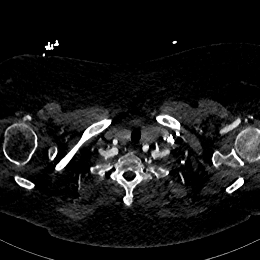 File:Aberrant right subclavian artery with Kommerell diverticulum (Radiopaedia 47982-52769 Axial C+ arterial phase 6).png
