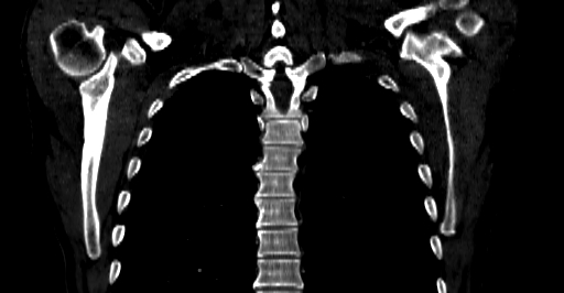 File:Accesory rib joint (Radiopaedia 71987-82452 Coronal bone window 38).jpg