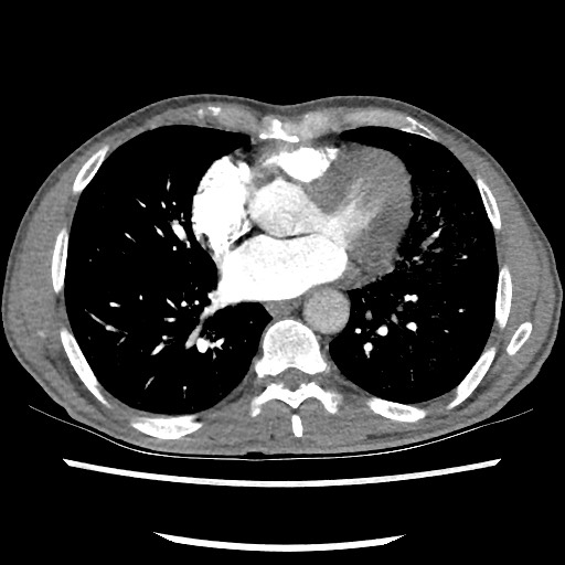 Accessory left horizontal fissure with lingular pneumonia (Radiopaedia 53763-59843 Axial C+ CTPA 59).jpg