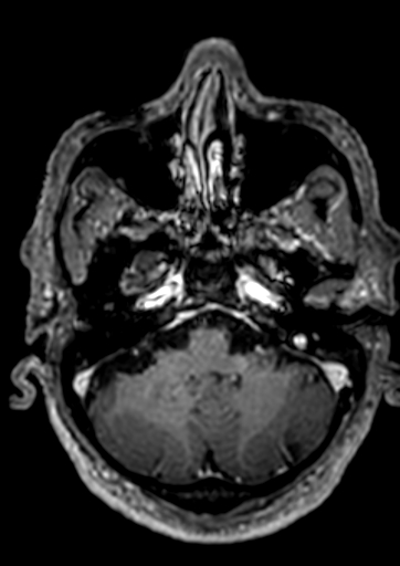 Accessory middle cerebral artery (Radiopaedia 73114-83828 Axial T1 C+ 138).jpg