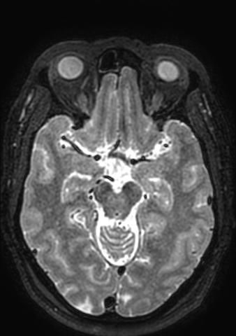 Accessory middle cerebral artery (Radiopaedia 73114-83828 Axial T2 113).jpg